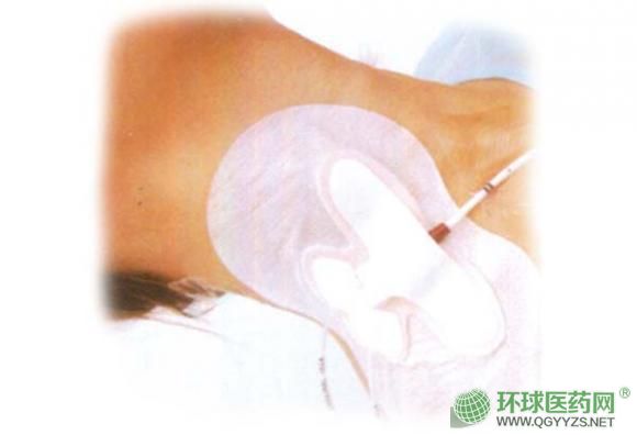 耗材體表導管固定裝置